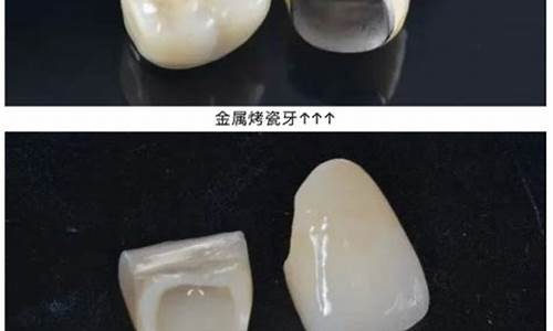 非贵金属烤瓷牙是什么意思_非贵金属烤瓷牙是什么意思啊